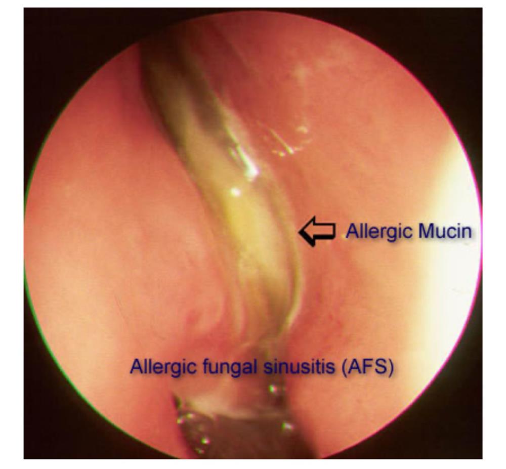 VIÊM MŨI XOANG DO NẤM